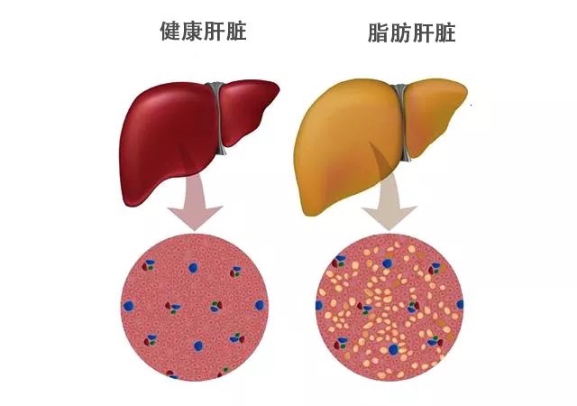 肝脏怎么越来越”胖“了？